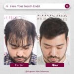 Direct hair transplant