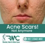 Acne Scars
