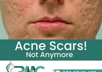 Acne Scars