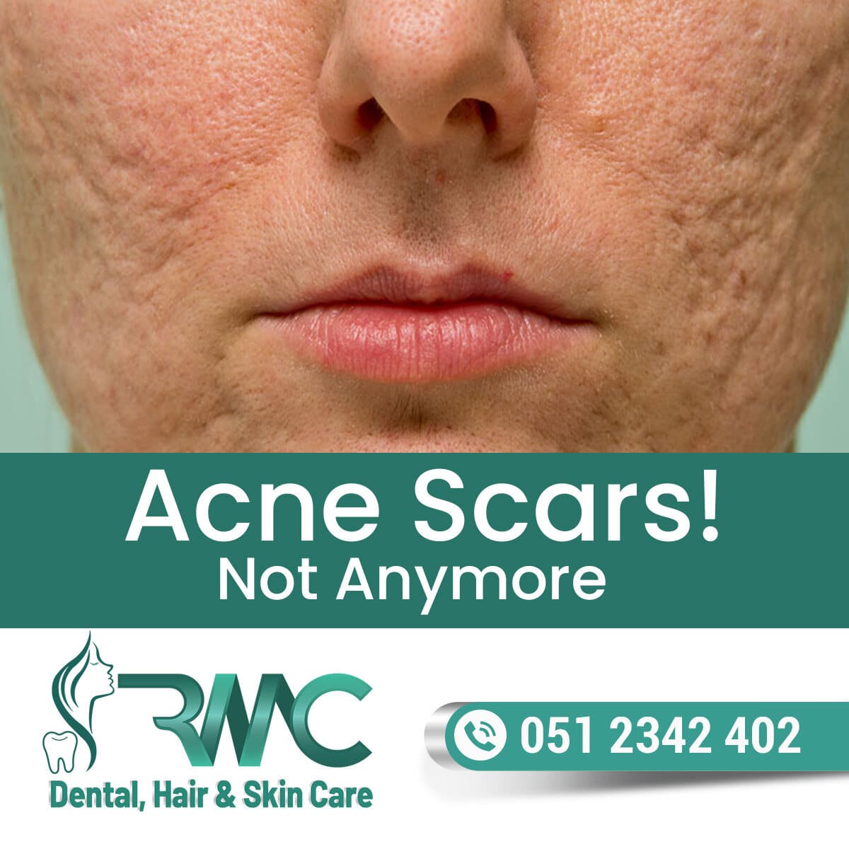 Laser Treatment For Acne Scars in Islamabad R M C
