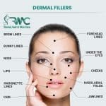 Restylane Filler