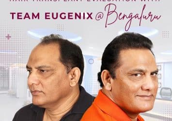 Hair Transplant