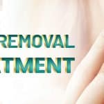 Laser Mole Removal