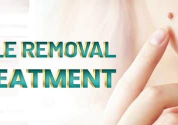 Laser Mole Removal