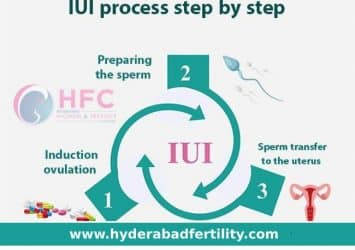 IUI Treatment in Hyderabad