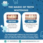 Dental Cleaning Polishing in Pimple Saudagar