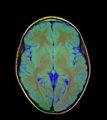 13 Brain MRI T1W R FLAIR G T2W TSE B