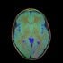 13 Brain MRI T1W R FLAIR G T2W TSE B