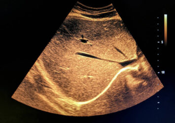 Comprehensive Liver Ultrasound Scan by Marris Medical