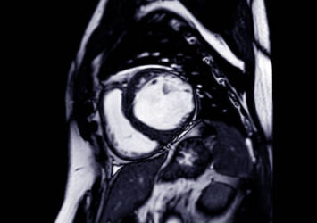 Heart MRI Scan: Advanced Cardiac Imaging by Marris Medical