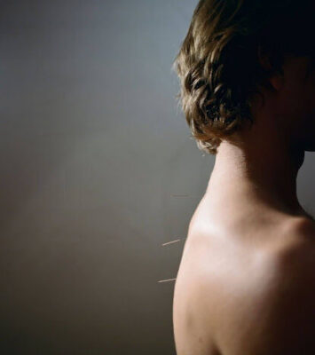 Acupuncture Upper East Side Treatments