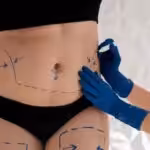 Non-surgical Liposuction in Dubai -Dr. Mohan Plastic Surgeon