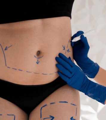 Non-surgical Liposuction in Dubai -Dr. Mohan Plastic Surgeon